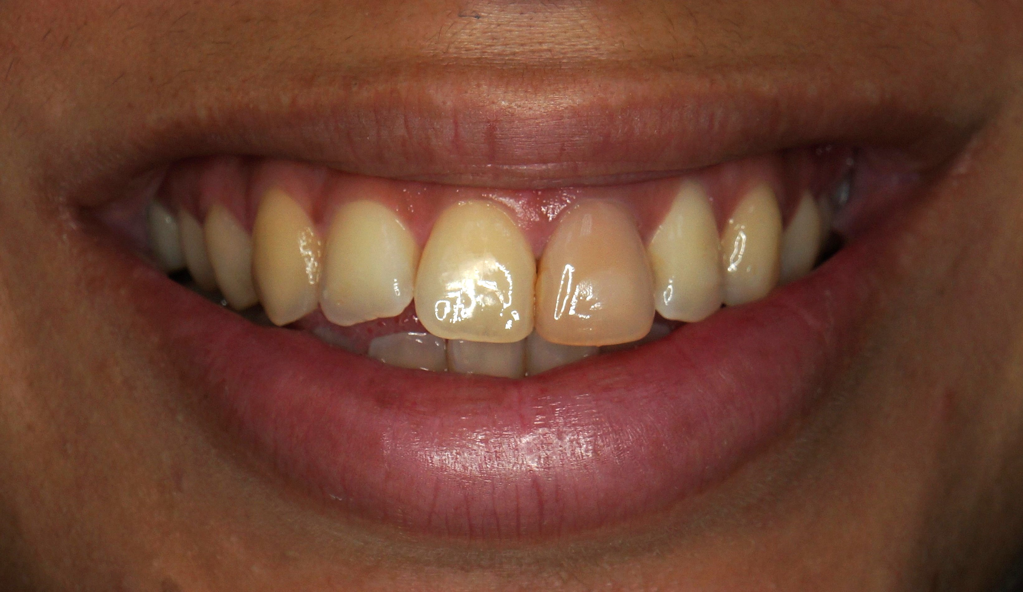 Clareamento Dental - Antes